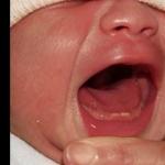 Чем лечить чихание, кашель и насморк без температуры у ребенка